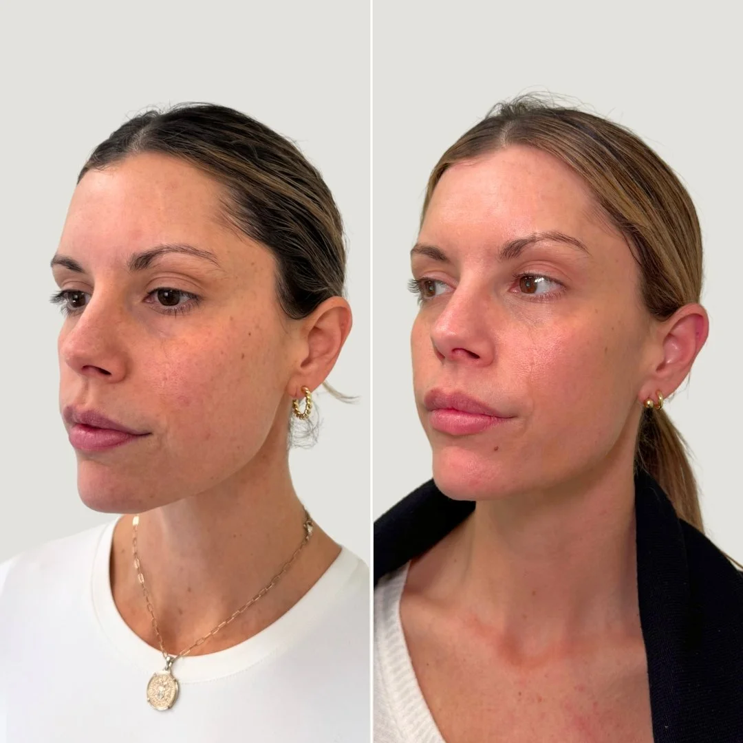 After 2 PRF Treatments for Undereyes + Sculptra
