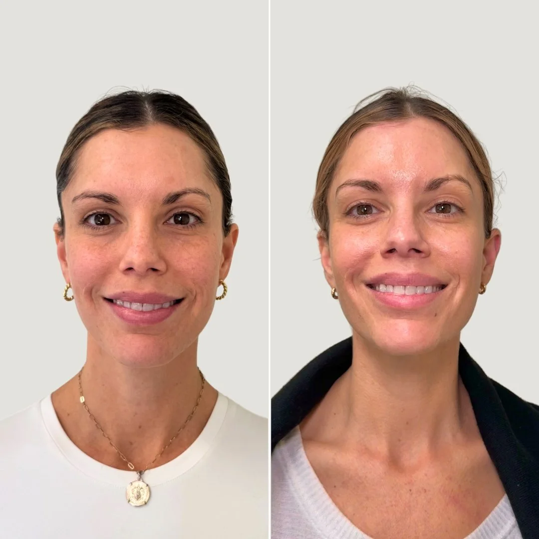 After 2 PRF Treatments for Undereyes + Sculptra