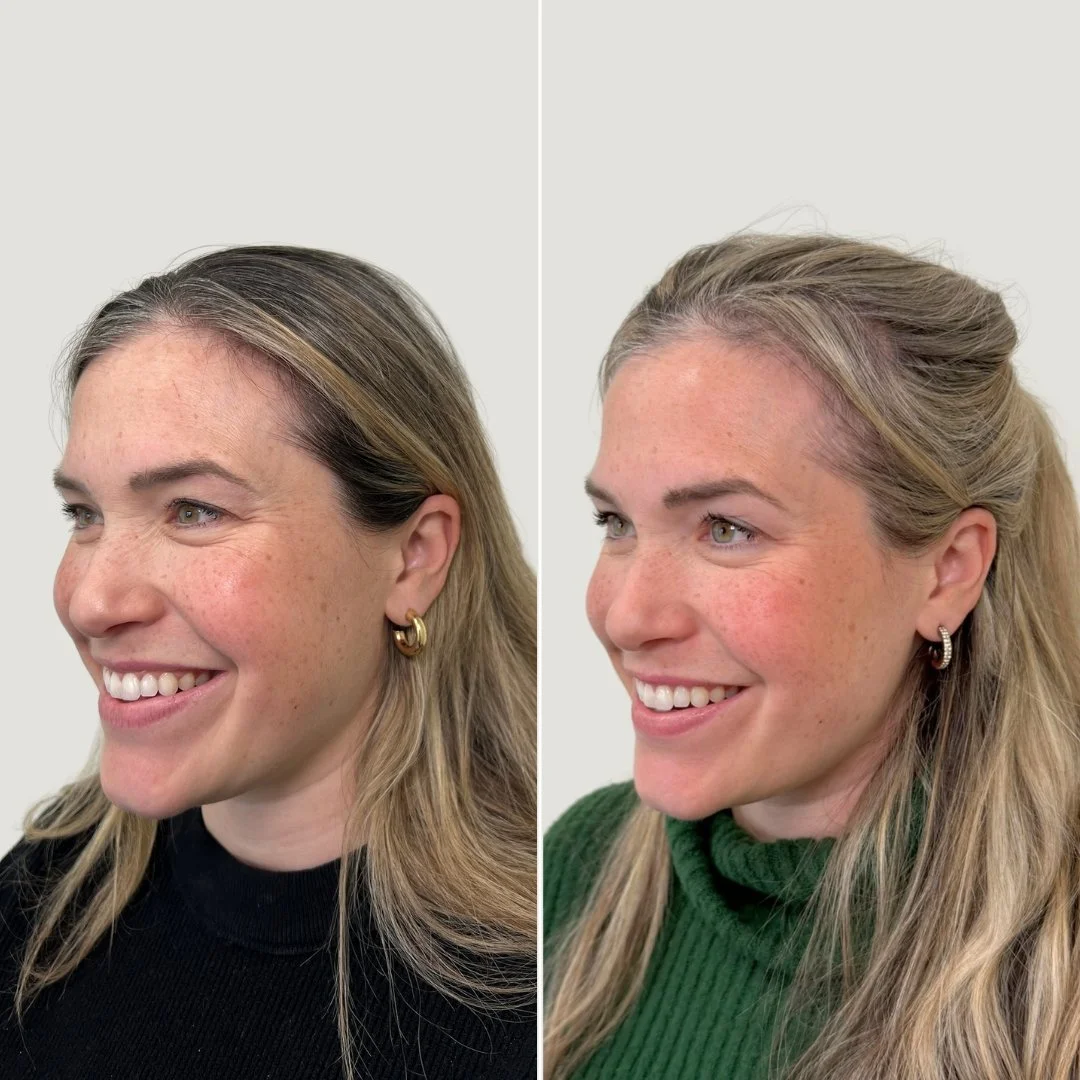 After 1 PRF Undereye Treatment + 1 PRP Treatment for the Face