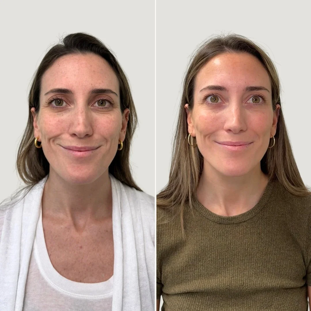 After 1 PRF Treatment for Undereyes + Sculptra