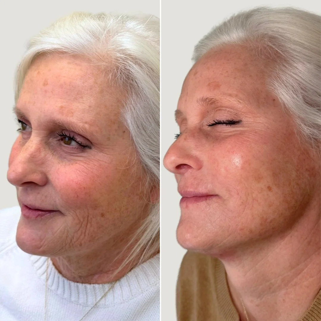 After 1 Skinvive Treatment