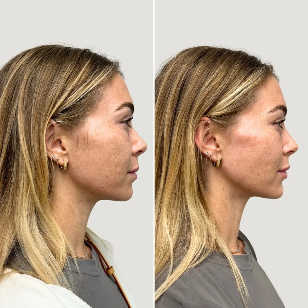 Cheek, Chin, Lip, + Jawline Filler
