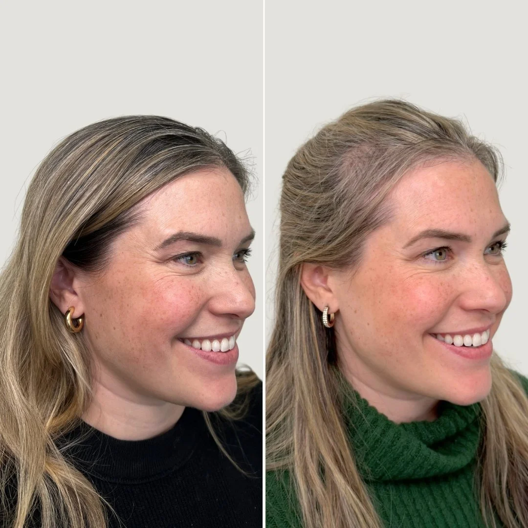 After 1 PRF Undereye Treatment + 1 PRP Treatment for the Face