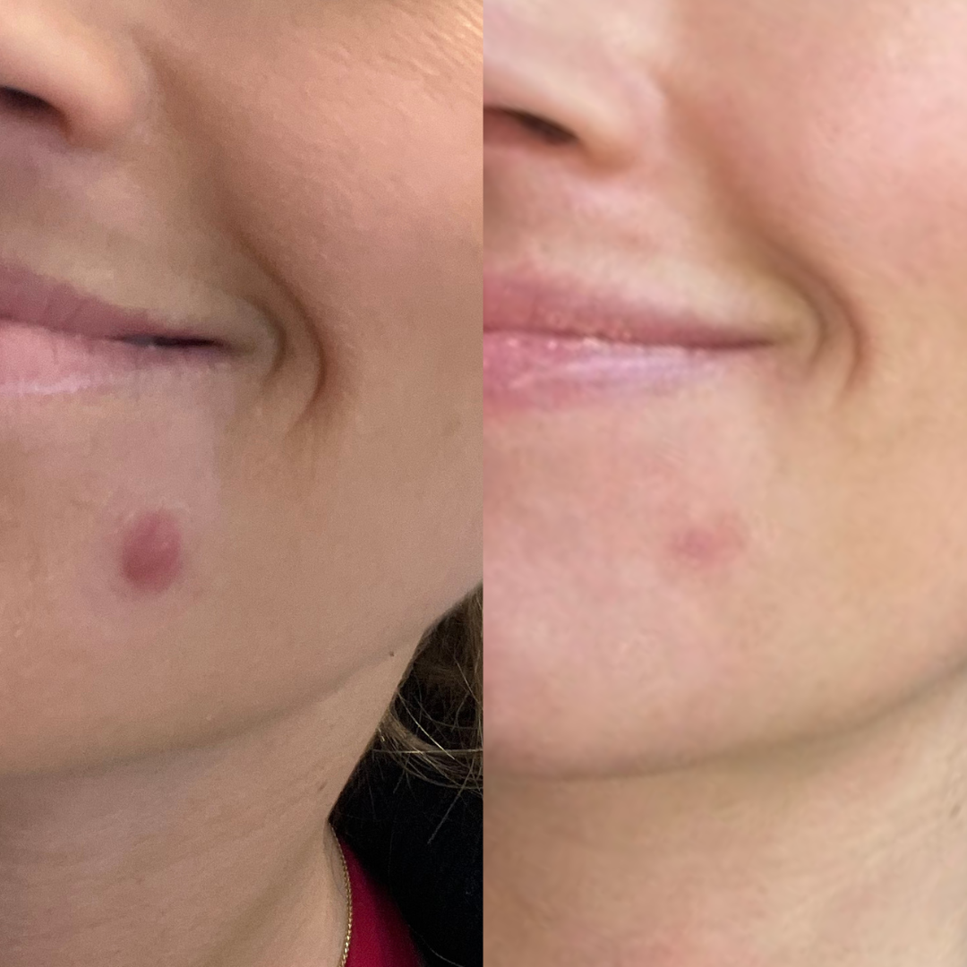 Before and after an acne injection at Skinship in Buckhead, Atlanta, showing a red chin breakout calmed down