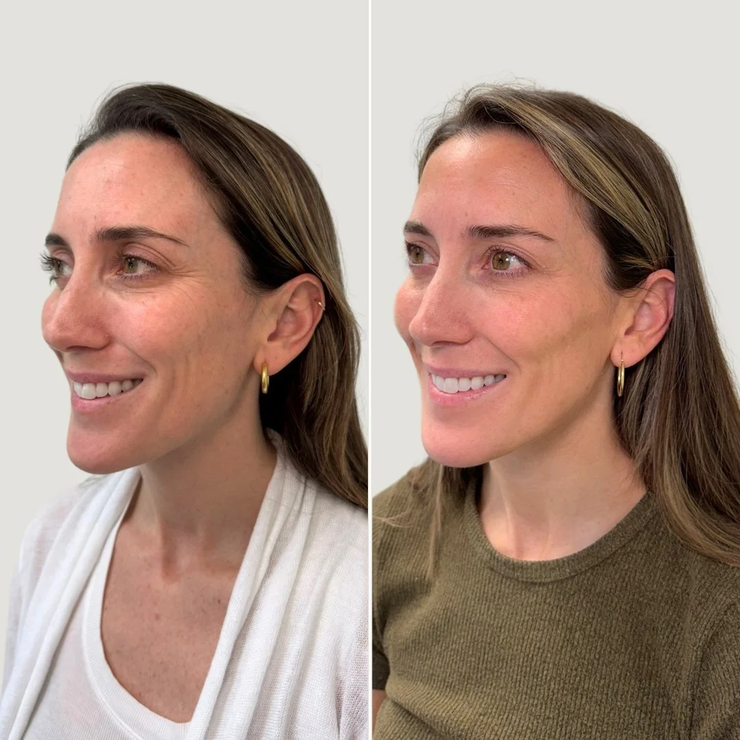 After 1 PRF Treatment for Undereyes + Sculptra