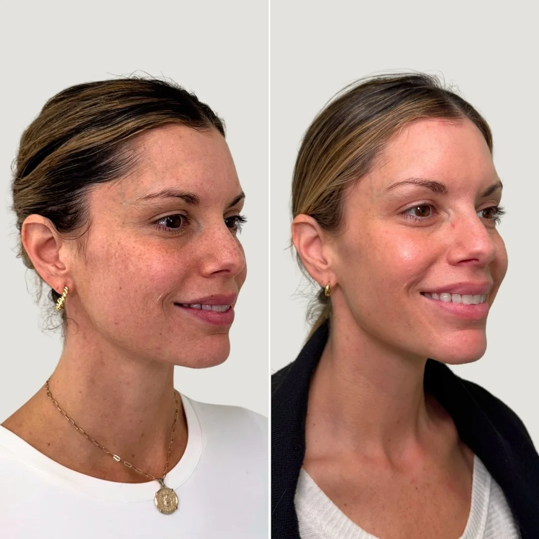 After 2 PRF Treatments for Undereyes + Sculptra