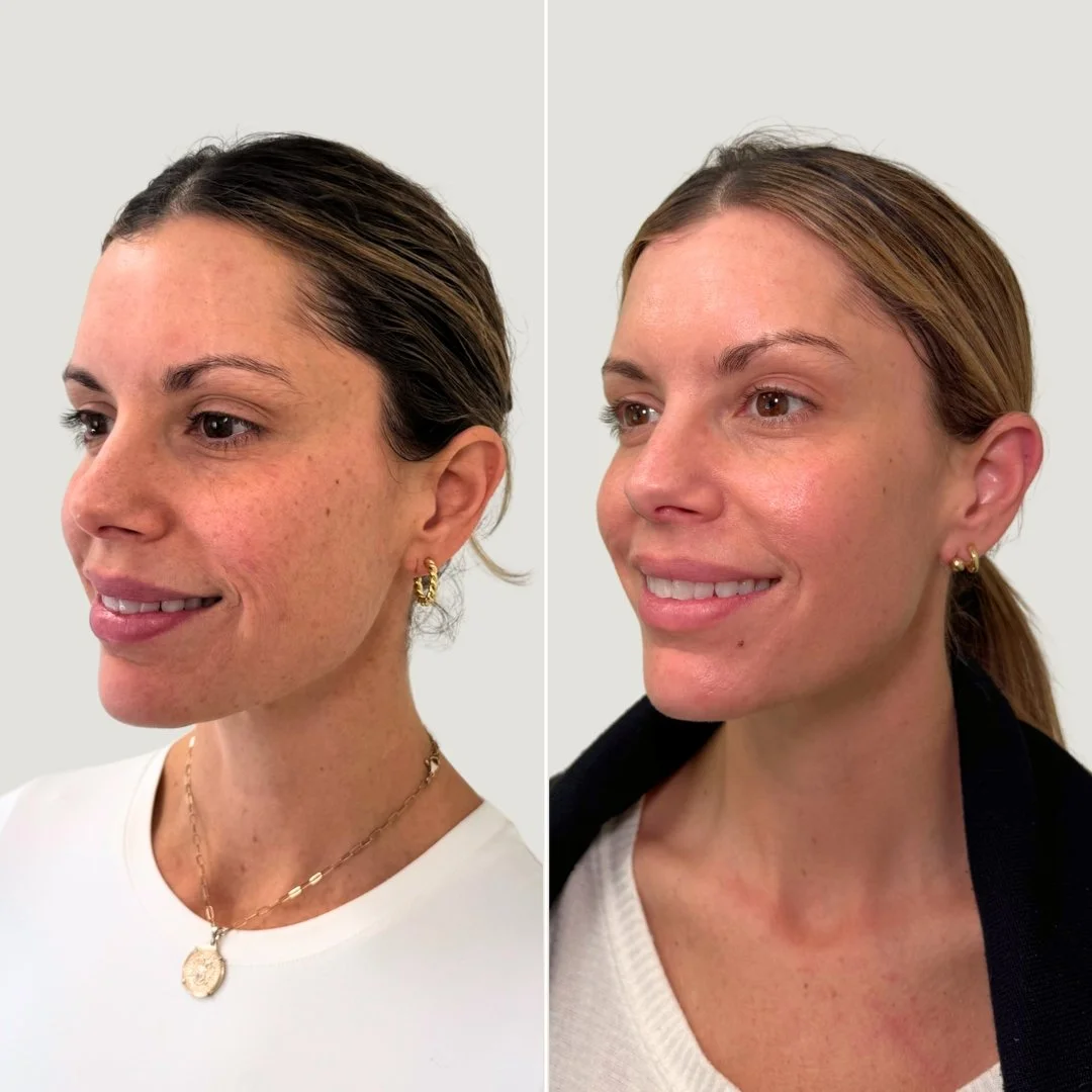 After 2 PRF Treatments for Undereyes + Sculptra