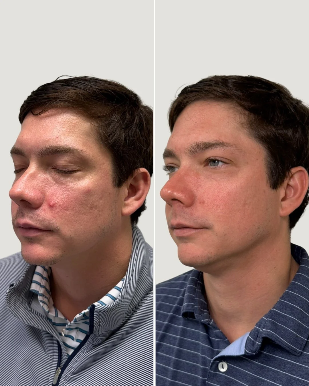 Acne injection before and after at Skinship Atlanta, showing inflamed cheek breakouts visibly calmer