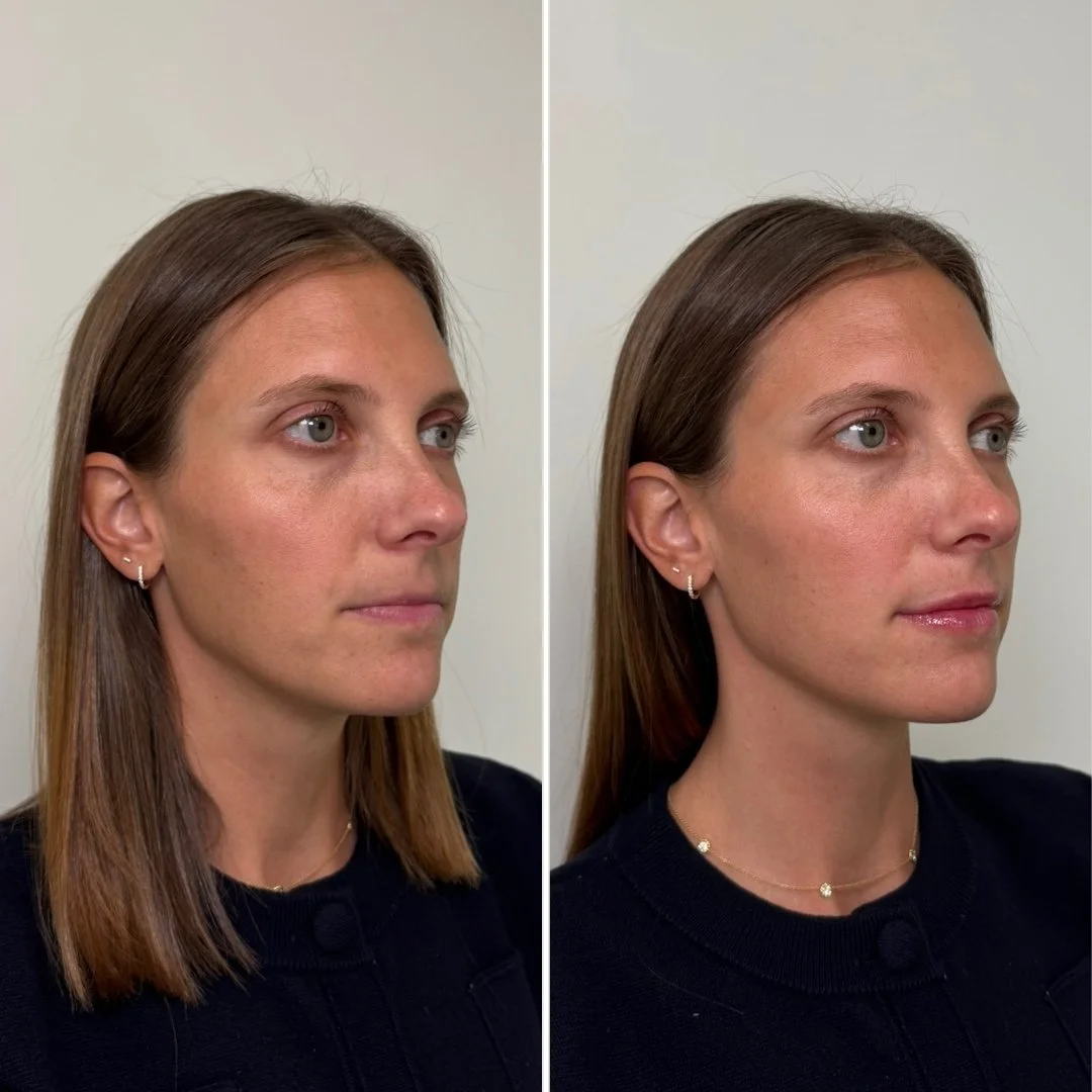 Lip Filler