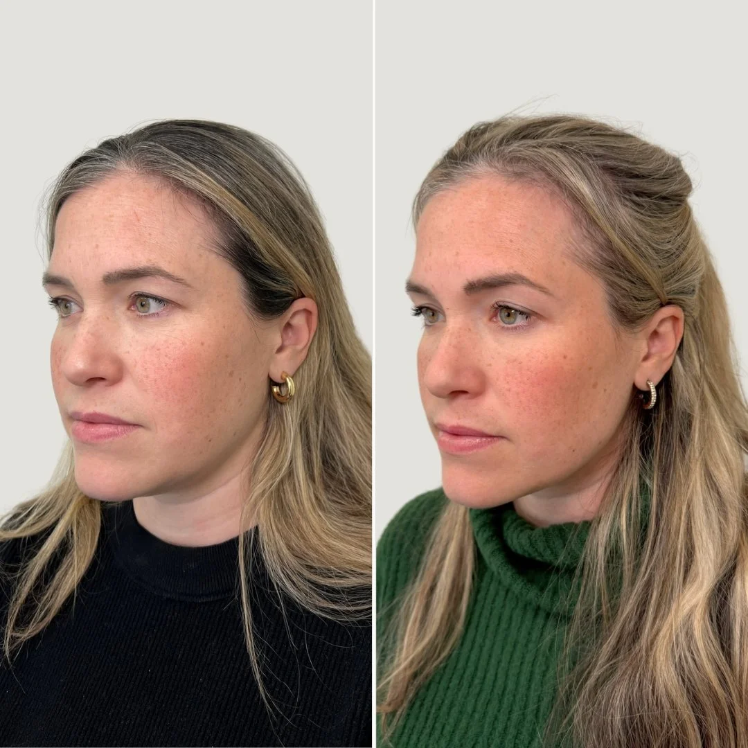 After 1 PRF Undereye Treatment + 1 PRP Treatment for the Face