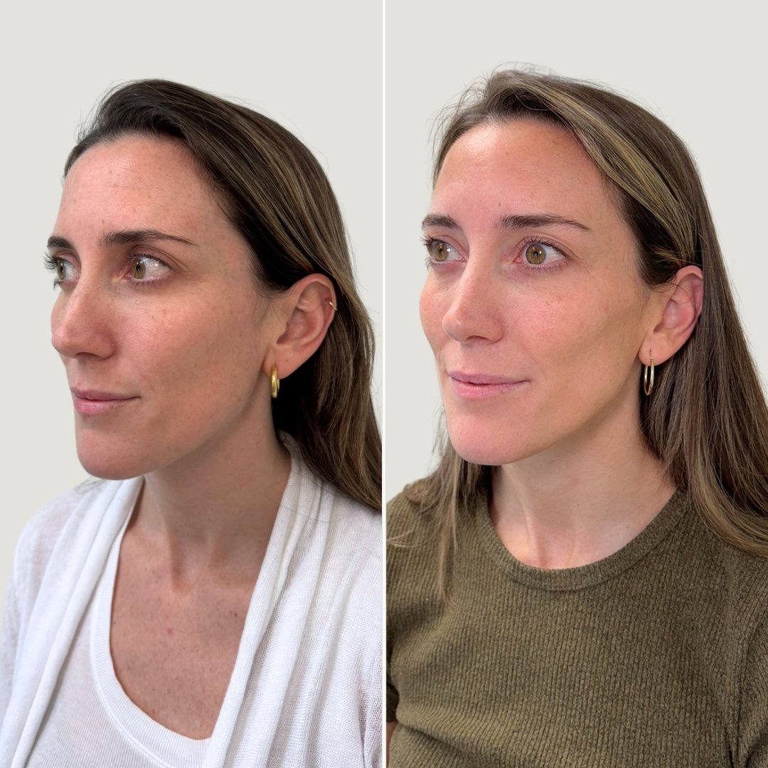 After 1 PRF Treatment for Undereyes + Sculptra