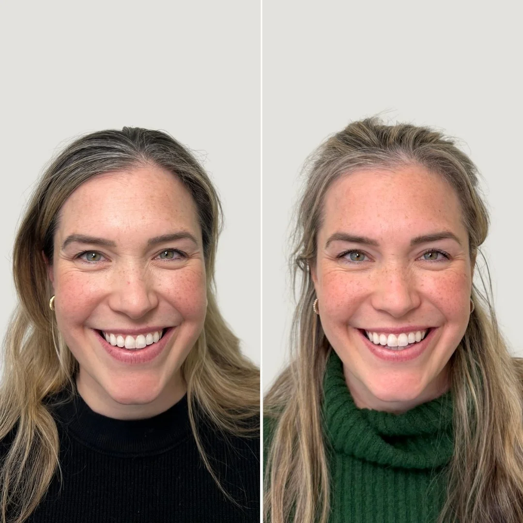 After 1 PRF Undereye Treatment + 1 PRP Treatment for the Face