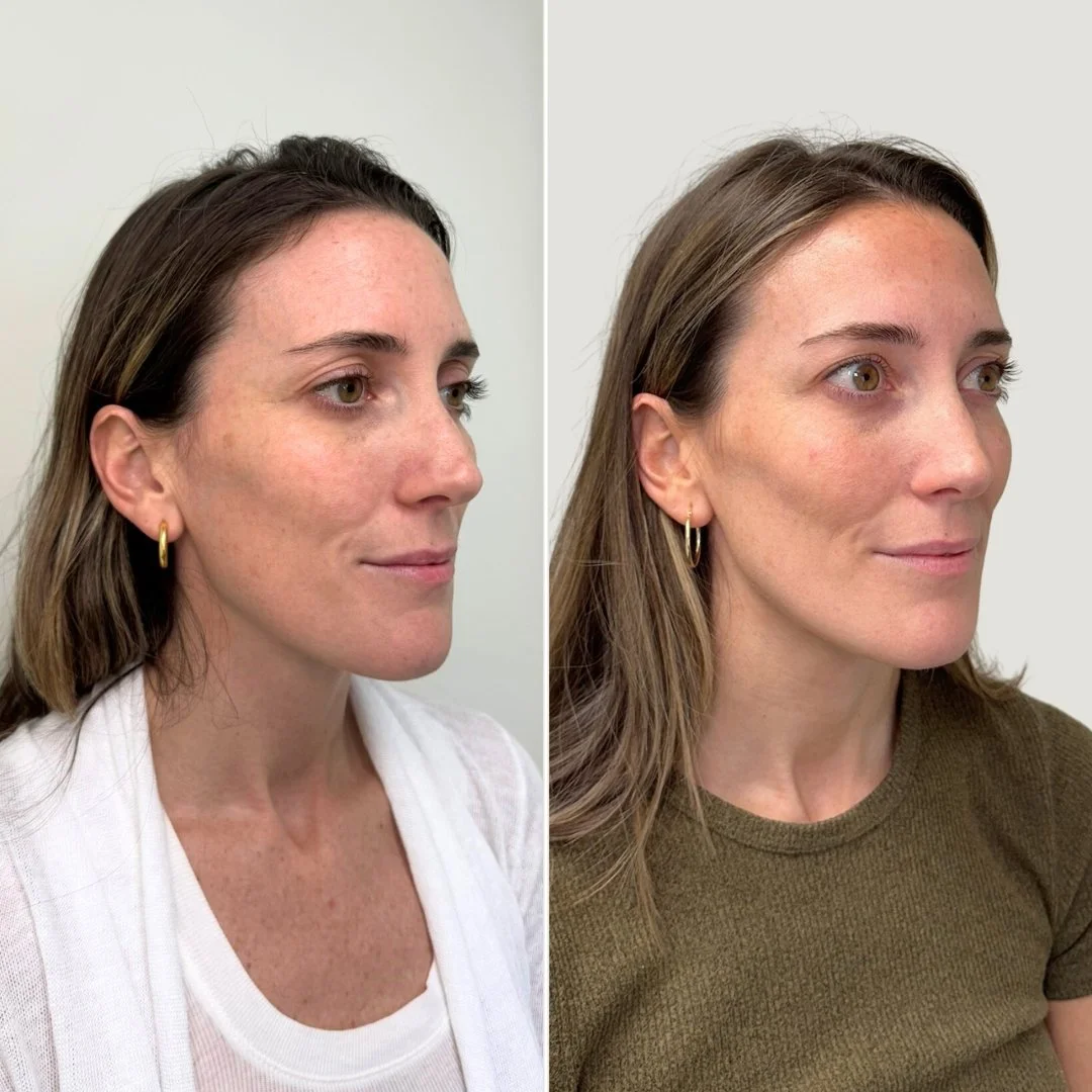 After 1 PRF Treatment for Undereyes + Sculptra
