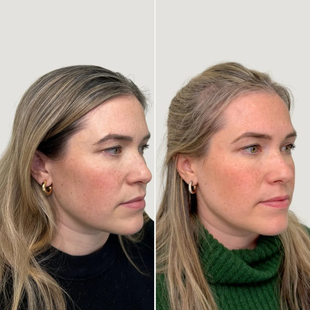 After 1 PRF Undereye Treatment + 1 PRP Treatment for the Face