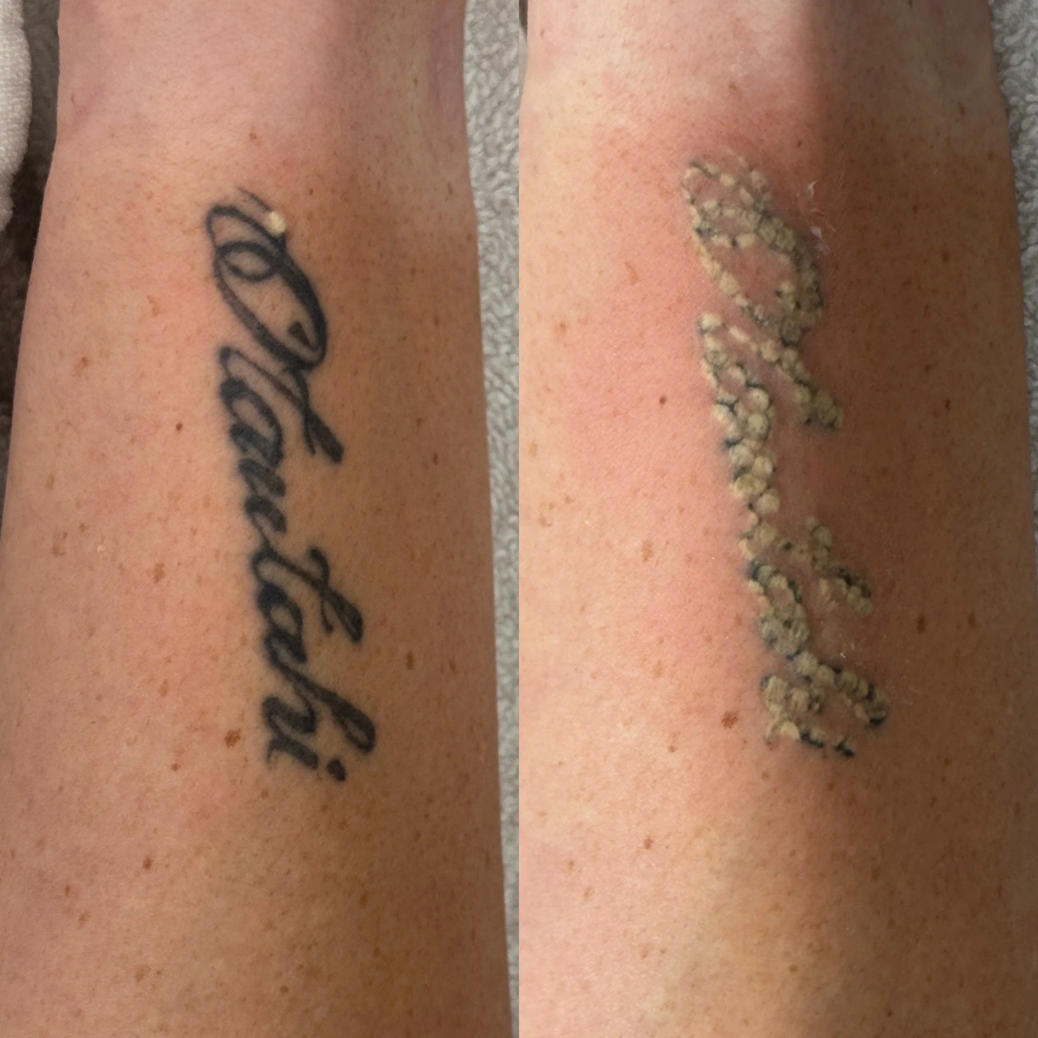 Laser Tattoo Removal Post Care