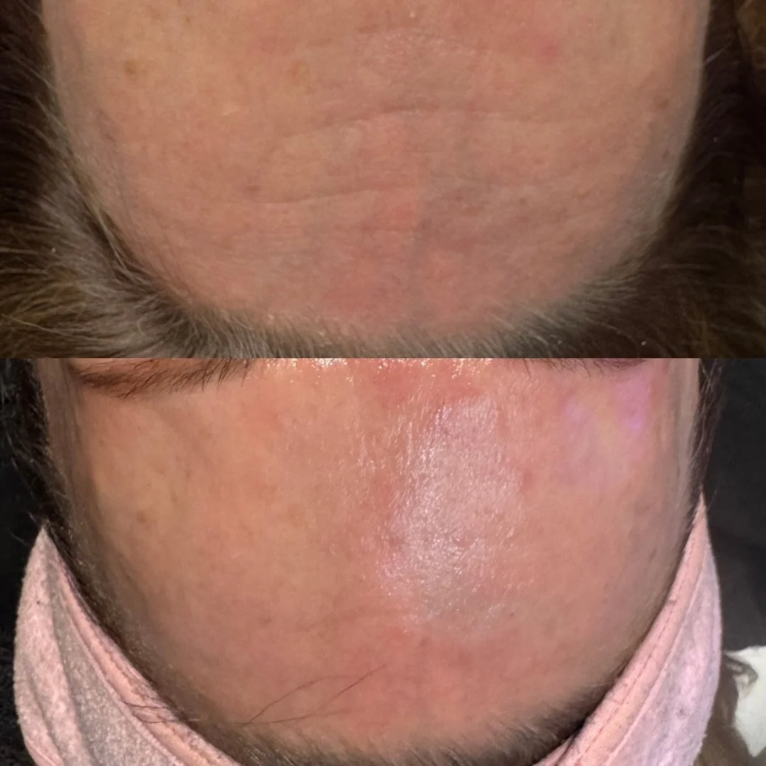 The Rezen Nano Facial is a non-invasive treatment designed to stimulate collagen production and improve overall skin health at a cellular level. Using advanced nano-technology, this facial enhances product penetration, supports skin regeneration, and