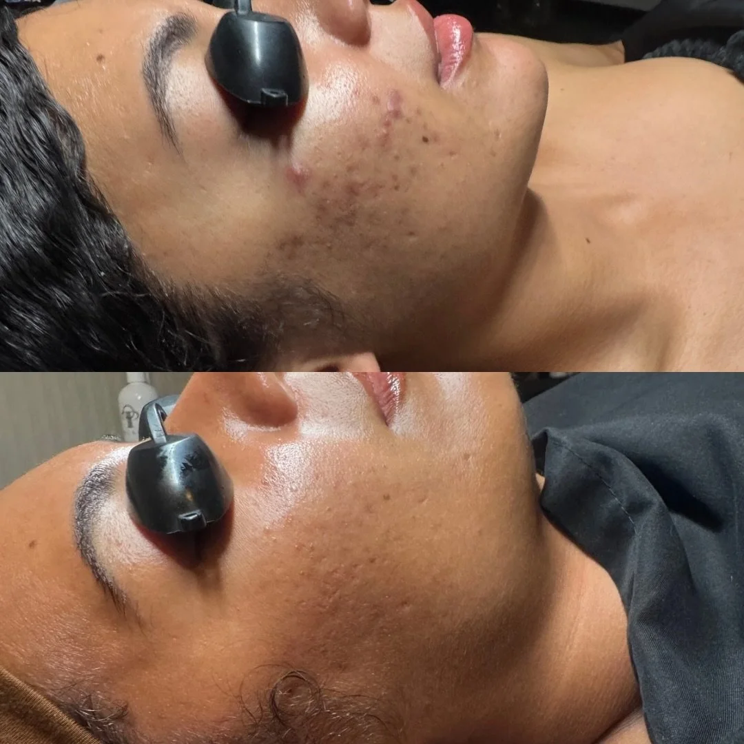 This is what progress looks like. 
A customized series of corrective peels + targeted at home regiment worked together to calm acne and lift pigment. When the routine is consistent, the results speak for themselves. 
Struggling with your skin? 
Exhal