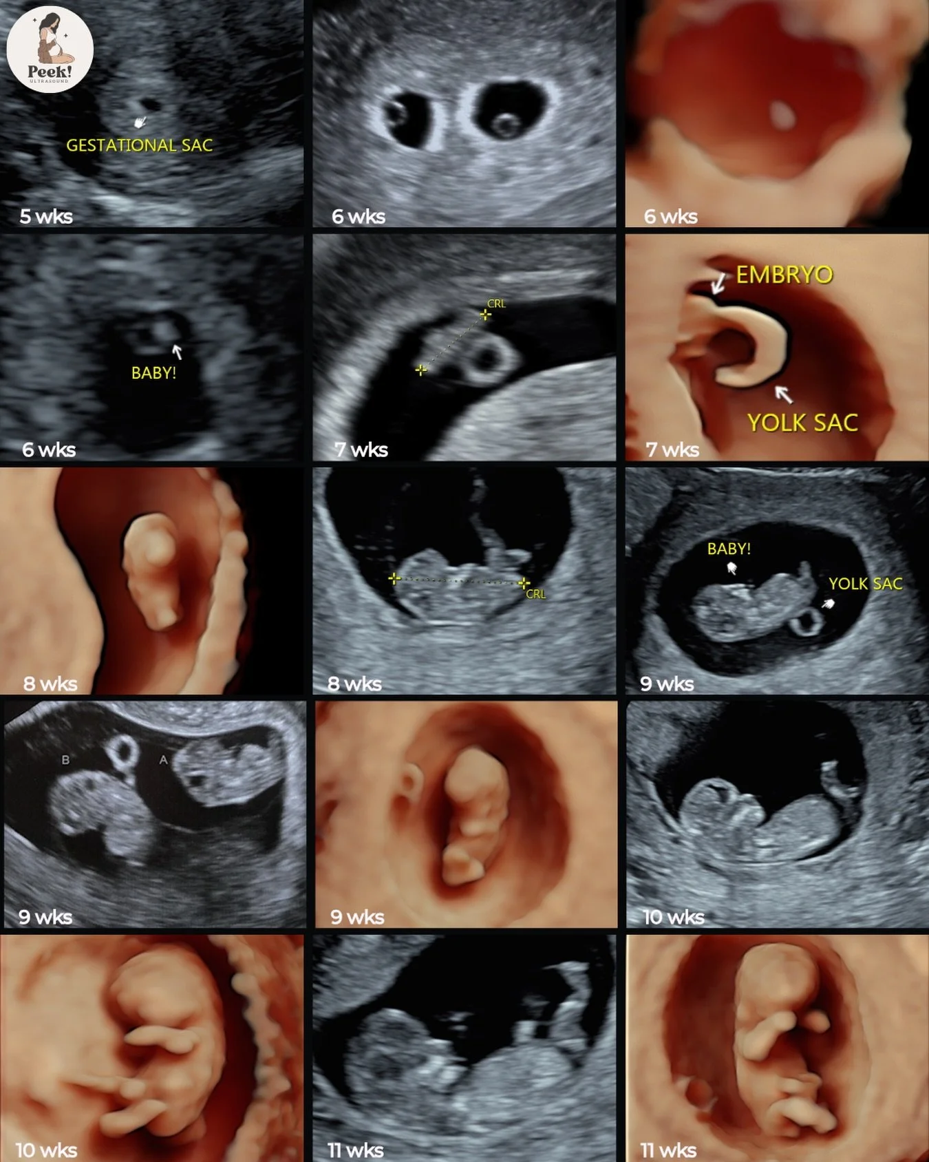 ✨ the first trimester is full of magic, even when baby is only the size of a poppy seed! here&rsquo;s a look at what we capture from 5&ndash;12 weeks during our early ultrasound sessions:

⭐ Weeks 5&ndash;6
&bull; gestational sac &amp; yolk sac becom