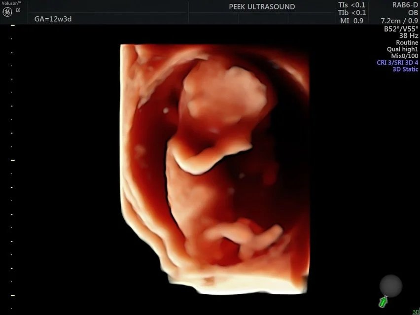 12w3d! ✨ baby&rsquo;s growing arms, legs, and facial features make for a breathtaking snapshot of life&rsquo;s earliest moments 🥹

book a Love at First Sight session for advanced 3D/4D/HD first trimester views up to 13 weeks! 

#ultrasound #firsttri