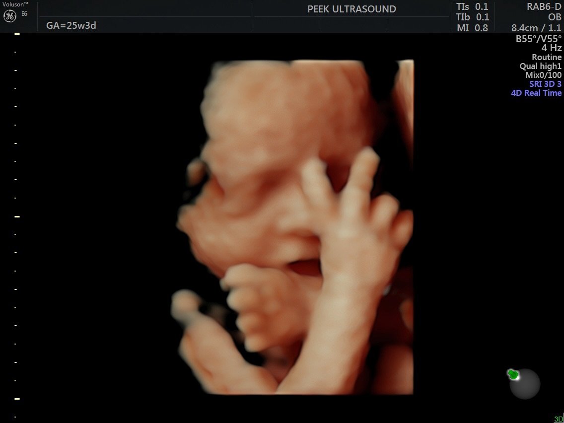 ✌🏻 Happy Monday from this sweet little peanut!

Ready to meet your baby?! June and July books are open! Plan your visit today for pregnancy memories you&rsquo;ll never forget 🩵🩷

#PeekUltrasound #HappyMonday #Peace #LongIslandMoms #PregnancyJourne