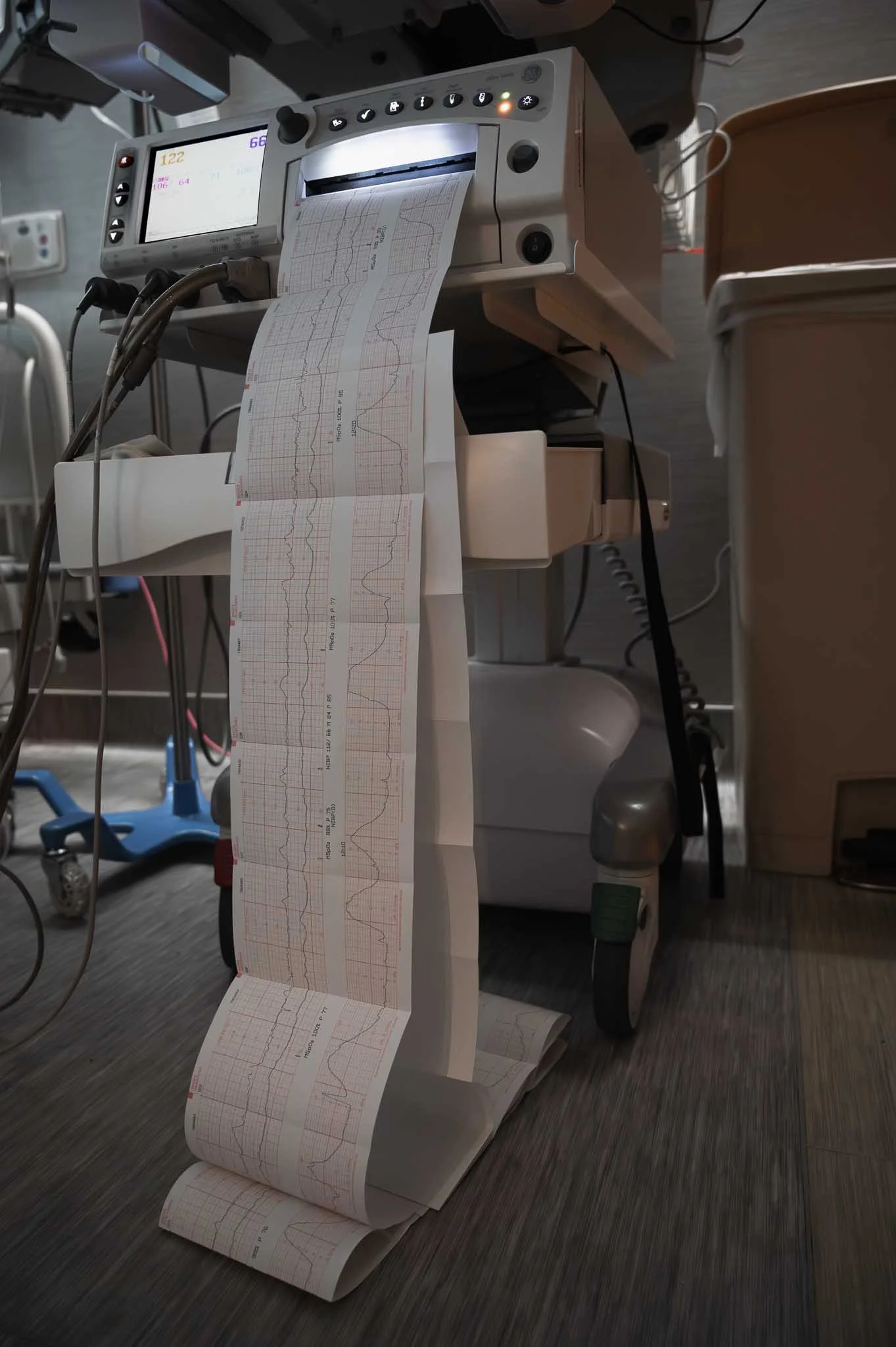 Medical monitor displaying vital signs next to a printout of an ECG with multiple graphs and waveforms, in a hospital setting.