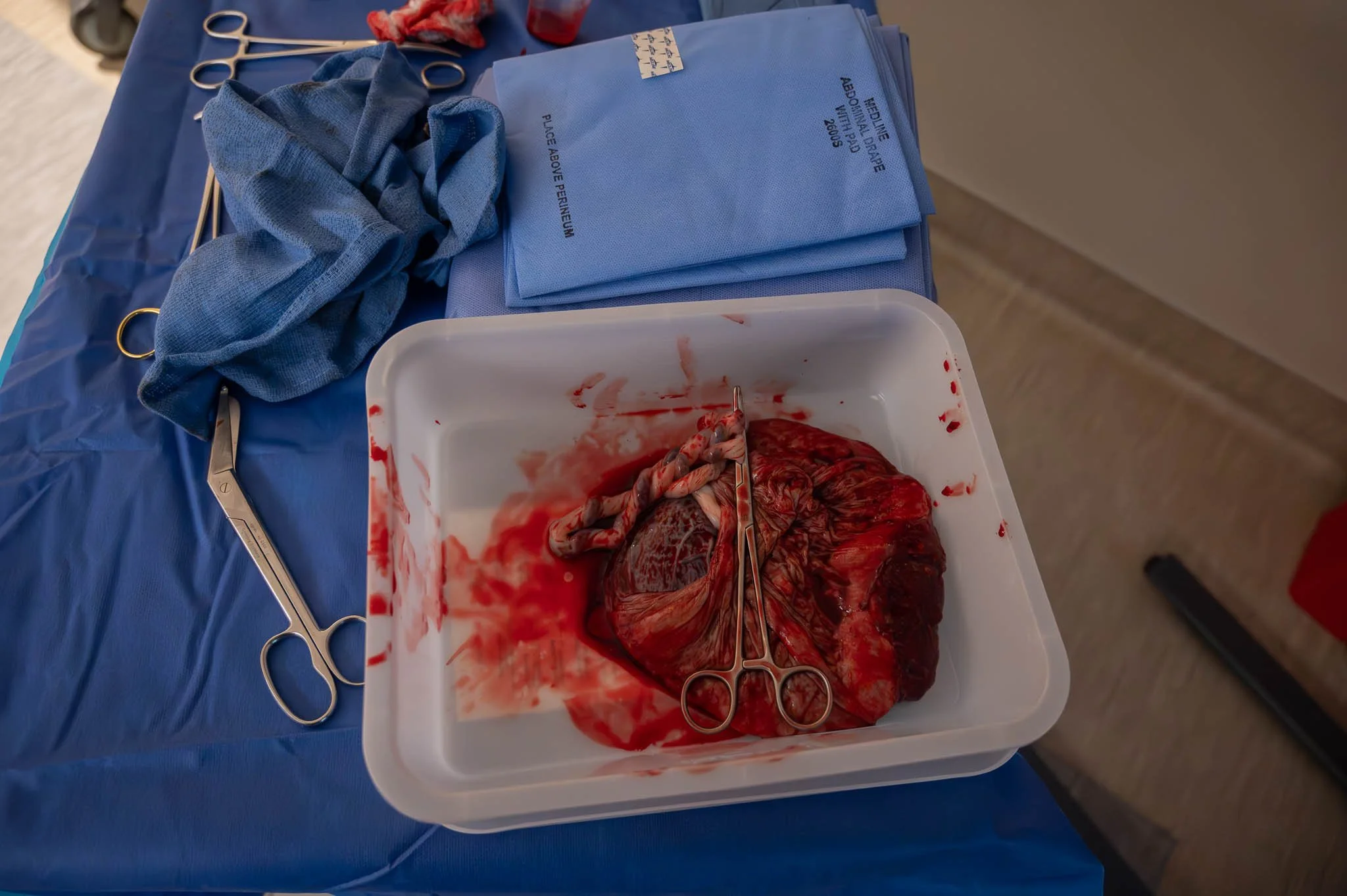 A medical tray containing a harvested heart and blood vessels, surrounded by surgical tools, blue surgical drapes, and sterile materials.