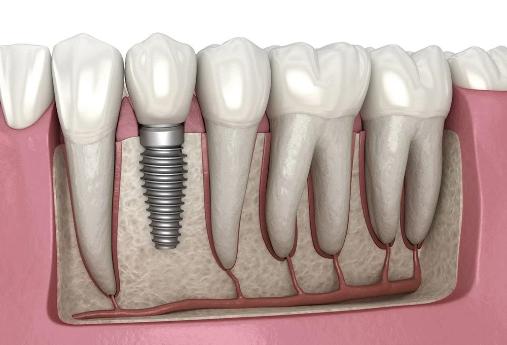 A dental illustration showing a dental implant placed within the jawbone, surrounded by natural teeth and gums.