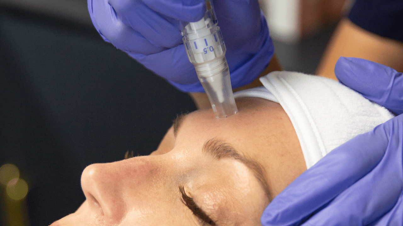 How Microneedling and PRP Improve Texture Scars