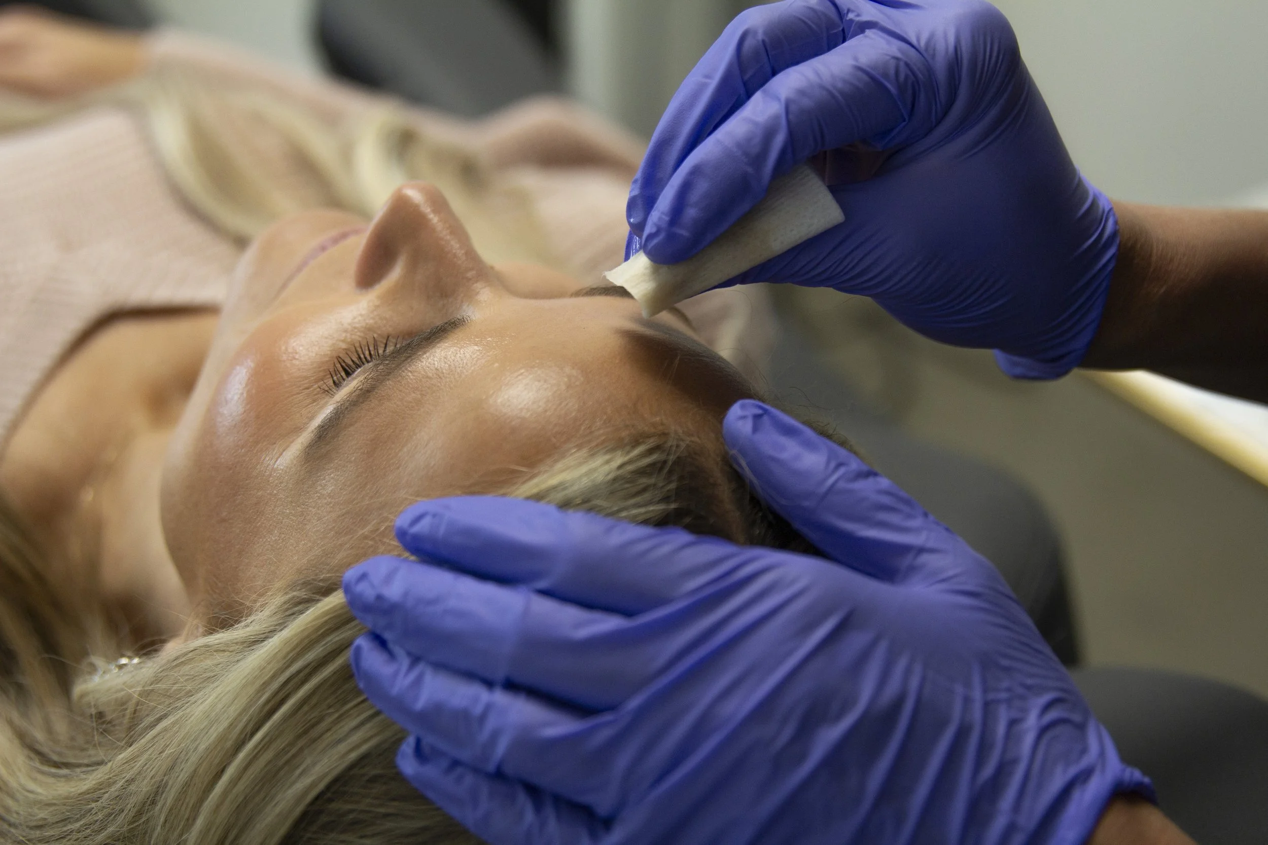 Chemical Peels for Hyperpigmentation and Melasma in Owasso