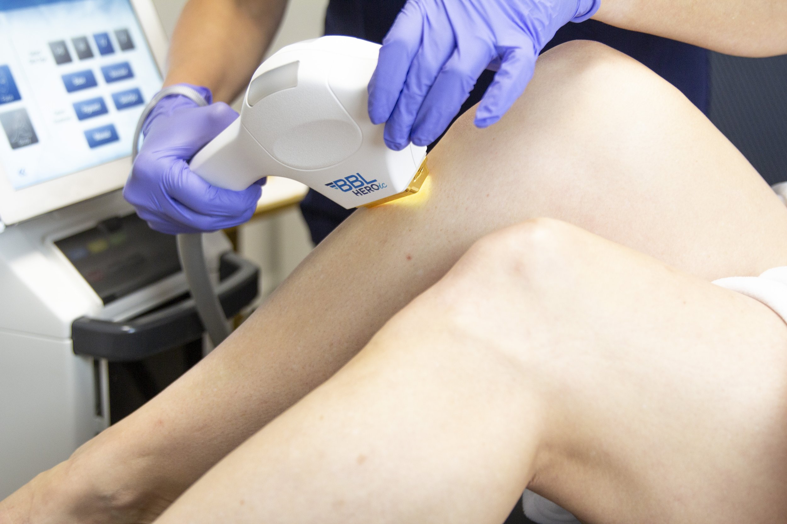 How Much Does Laser Hair Removal Cost in Owasso?