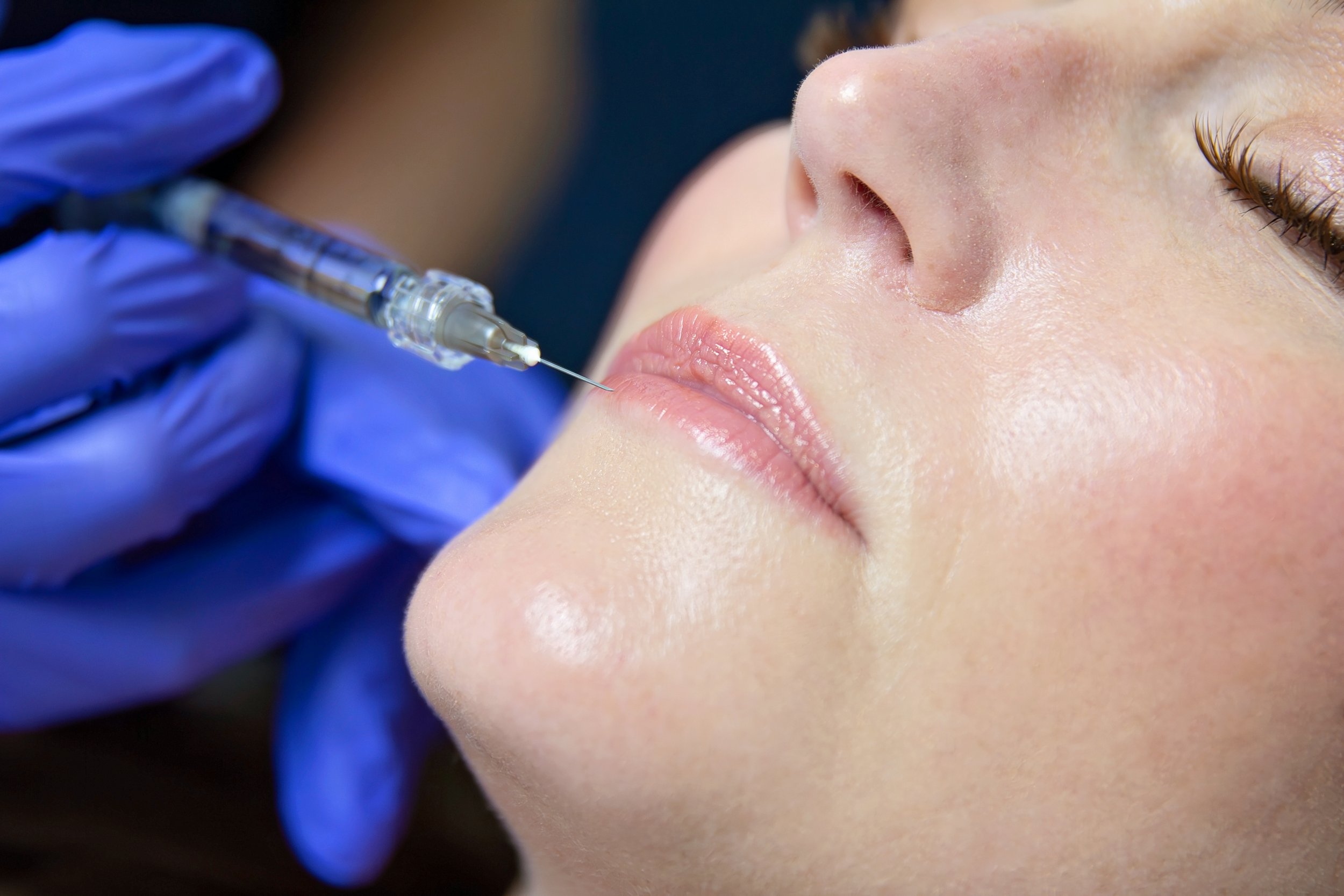 Close-up of a woman receiving a lip injection with a syringe by gloved hands.