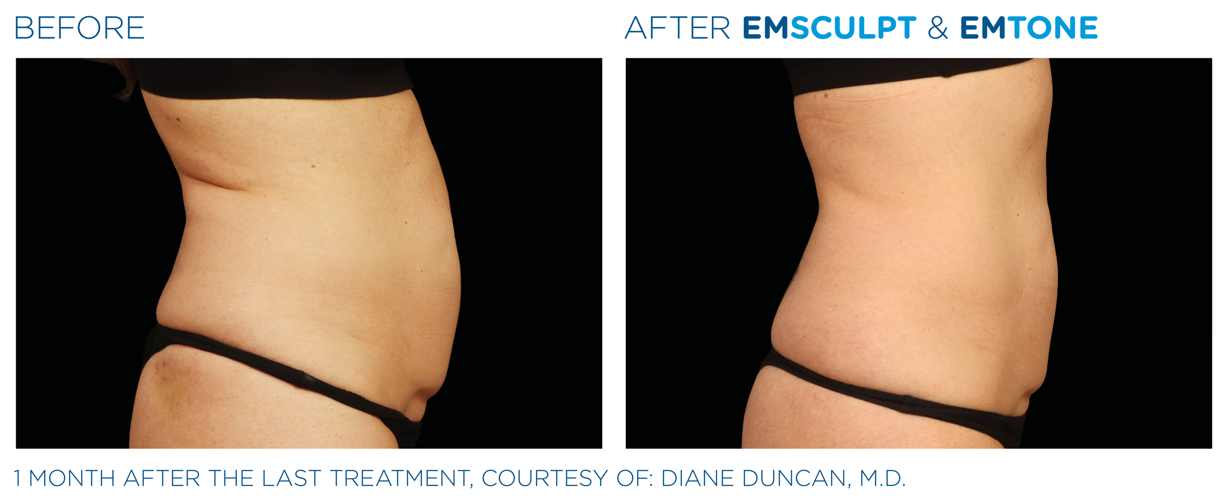 Emsculpt_Emtone_PIC_Ba-card-female-abdomen-016_ENUS100.png