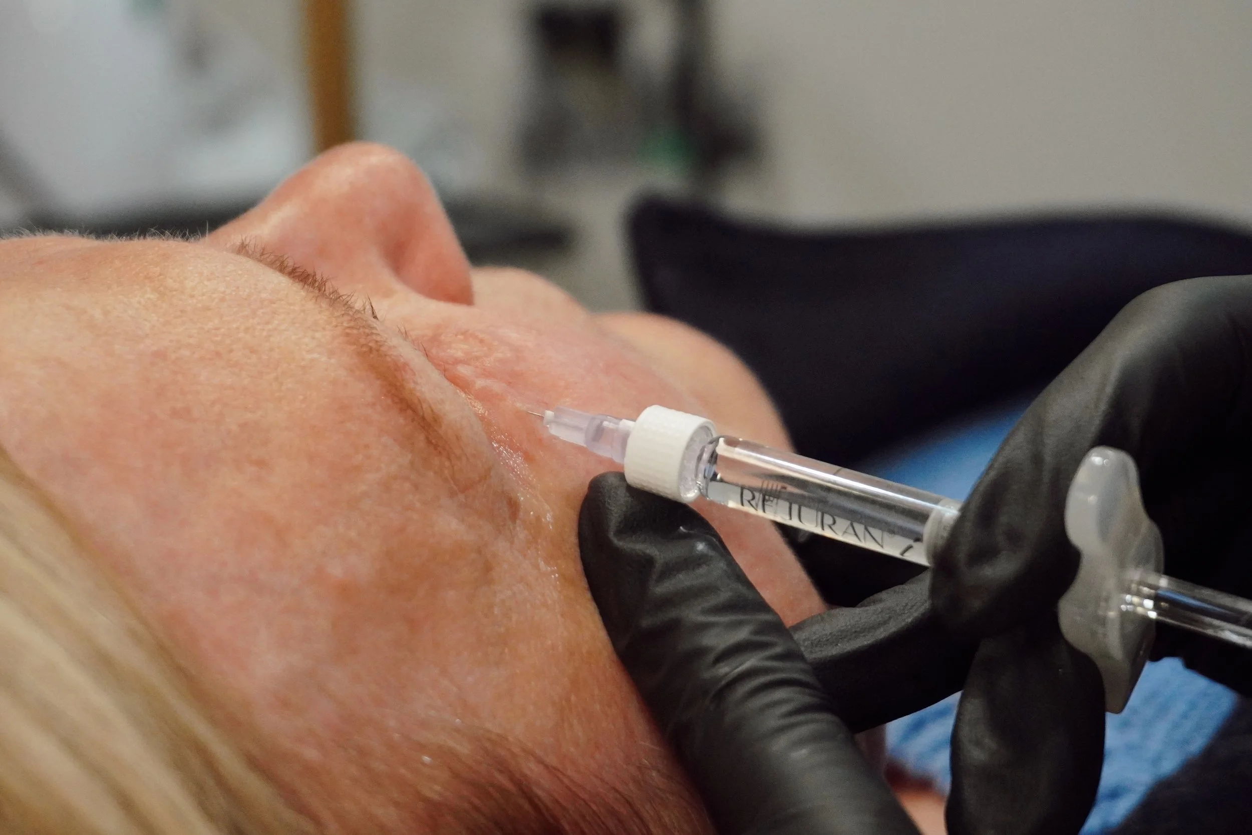 Close-up of a person receiving a facial injection from a healthcare professional wearing black gloves.