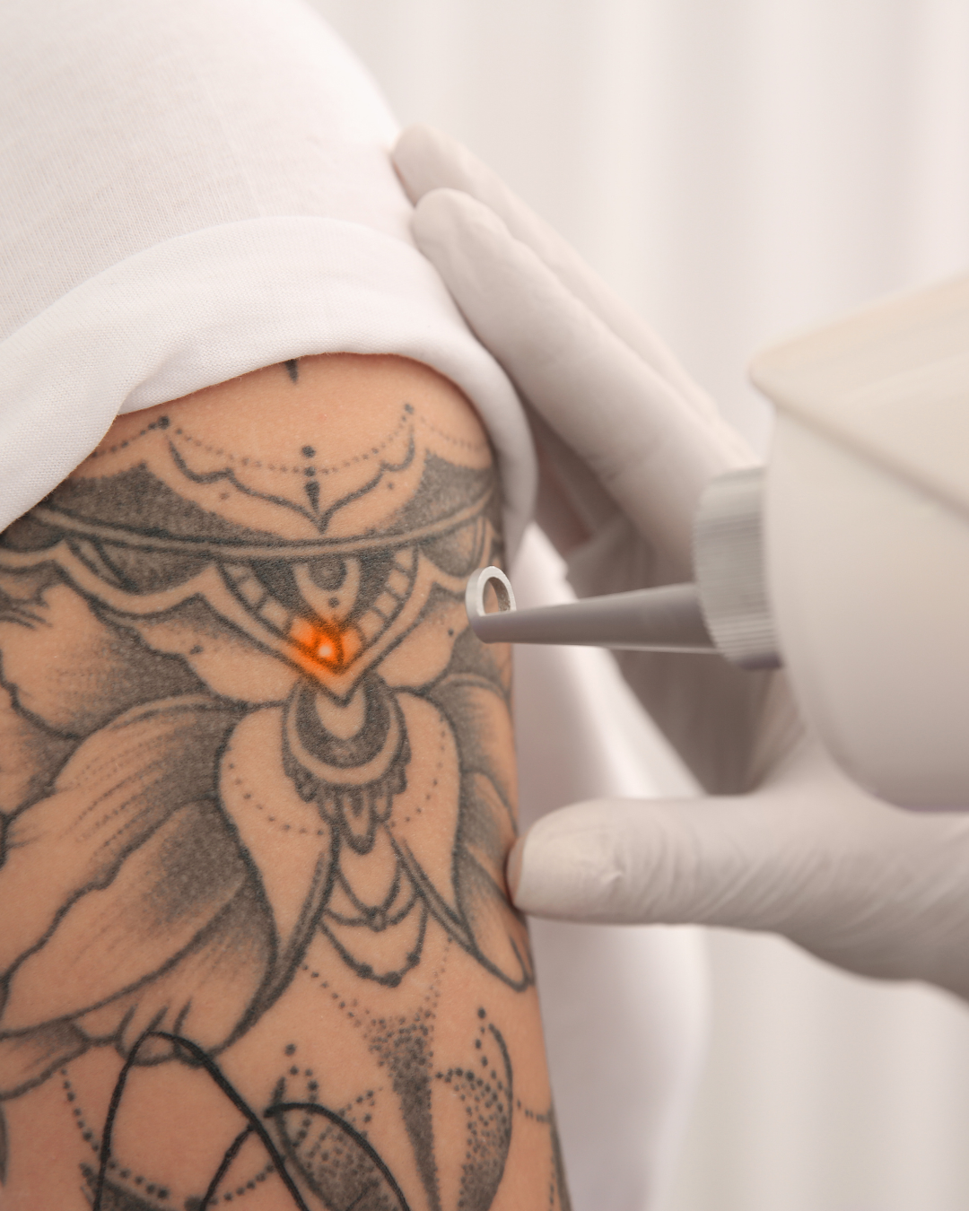 LASER TATTOO REMOVAL