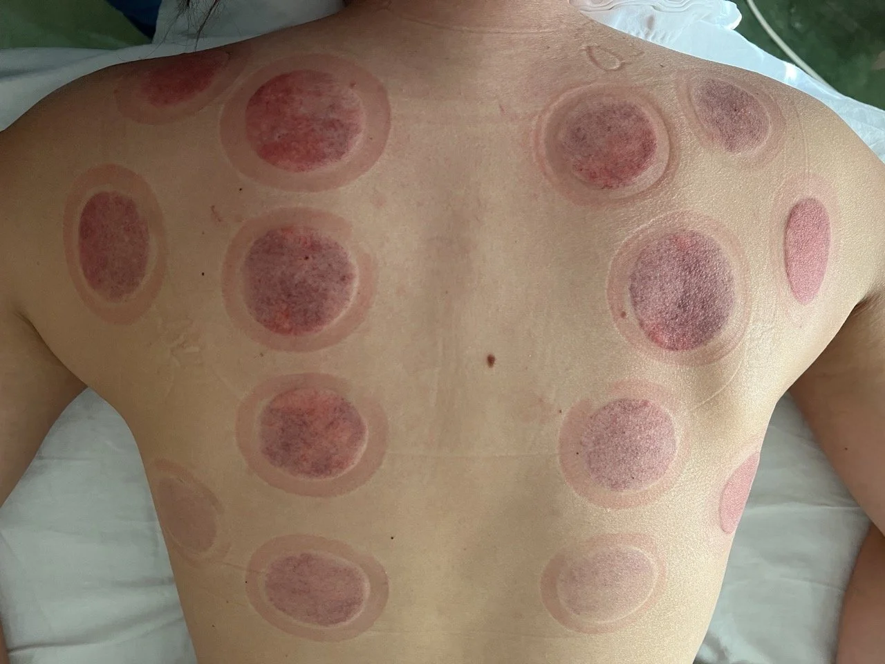 Patient after receiving cupping therapy in Glendale AZ at Empirical Medicine