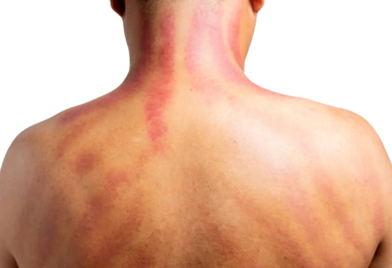 A patient after a Guasha treatment at Empirical Medicine in Glendale, AZ