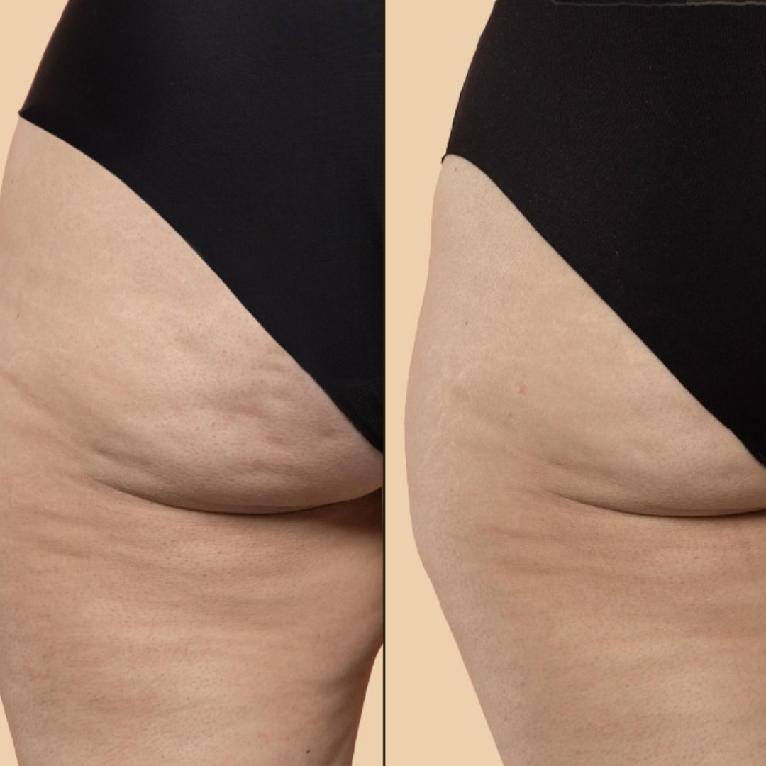 Natural Enzyme Anti-Cellulite Treatment