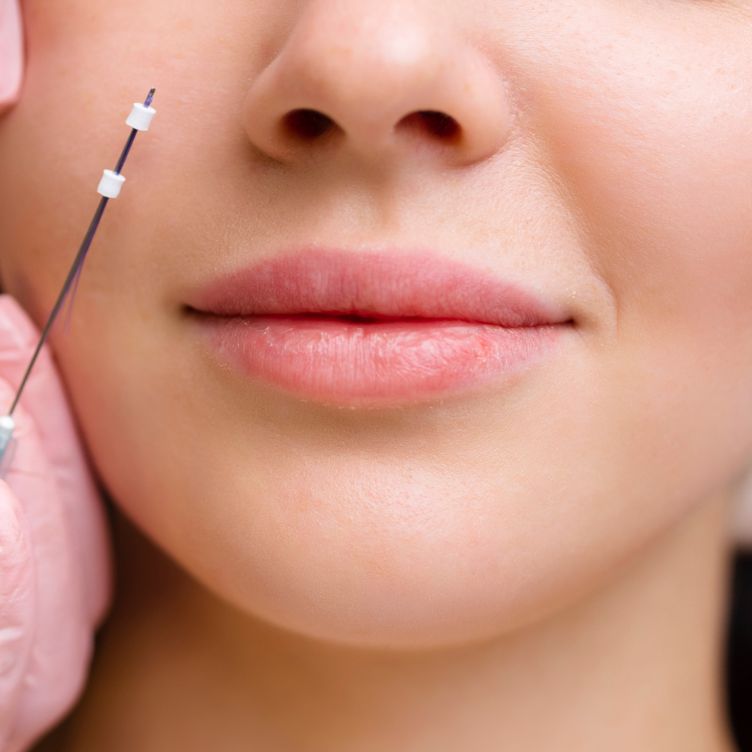 PDO Surgical Lifting Threads