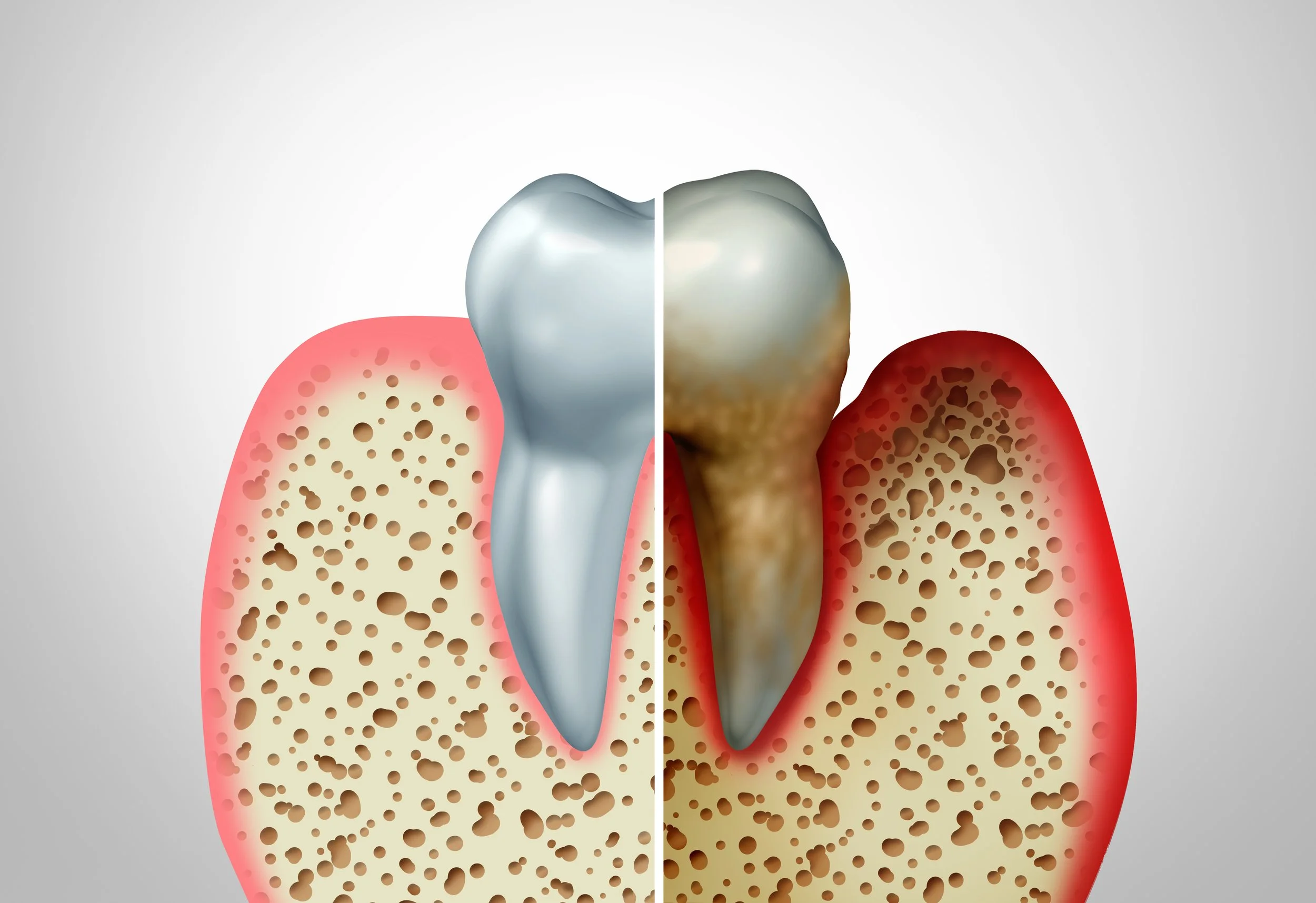 Understanding Periodontal Disease: Implications and the Importance of Treatment