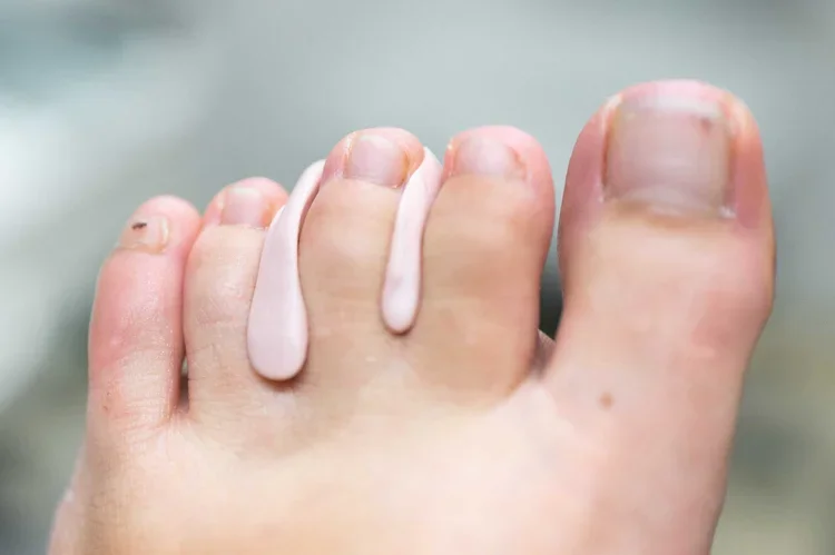 Nahaufnahme eines Fußes mit eingewachsener Zehennagel, der weißlich schimmert.