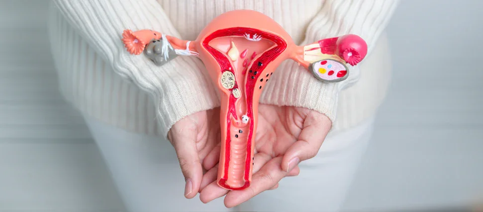 PCOS and the shift toward “PMOS”: rethinking a whole-body condition