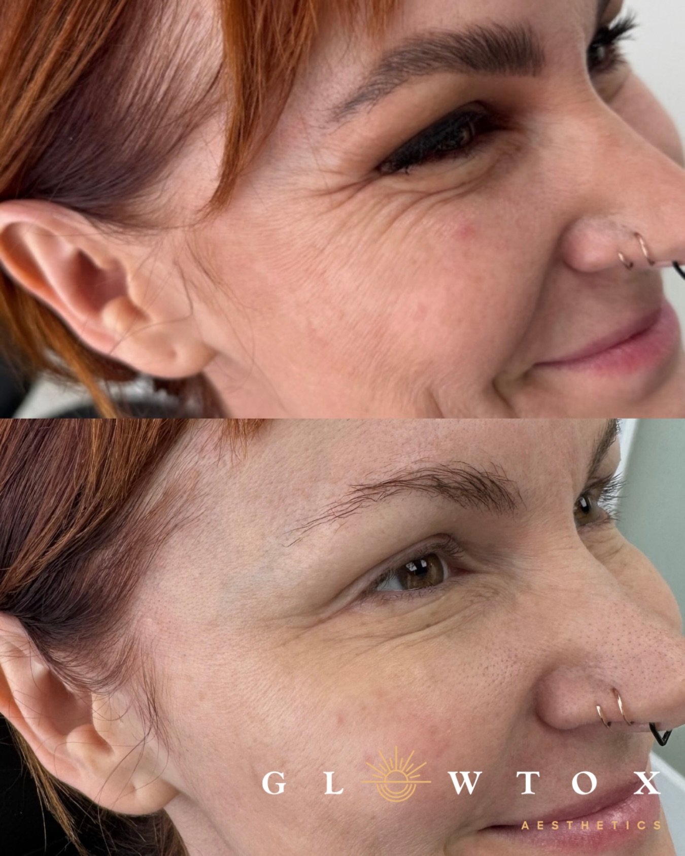 Same smile smoother lines ✨
Botox for crow&rsquo;s feet can make all the difference 

#pacificbeach #missionbeach #sandiego #glowup #glowtox #summer #wrinklefree #tox #smile #aesthetic #nurse #medspa #filler #sculptra #beforeandafter #beauty