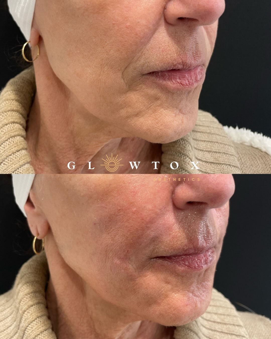 Subtle, Natural, Elevated ✨
This lovely patient was treated for cheeks &amp; nasolabial folds with filler, and you can already see a softened, smoother contour through the mid-to-lower face.
Notice how her jowls appear gently lifted and straighter? a