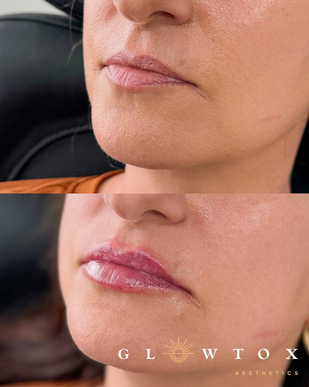 Every Kysse begins with K💋✨
To celebrate Restylane Kysse 5th Birthday we are giving the first 5 people to book lip filler with Nurse Netta &amp; Nurse Isabel $100 off !
✨
Glow up by: @Nurse._.Netta 
✨
&mdash;&mdash; B O O K I N G&nbsp;&nbsp;I N F O&