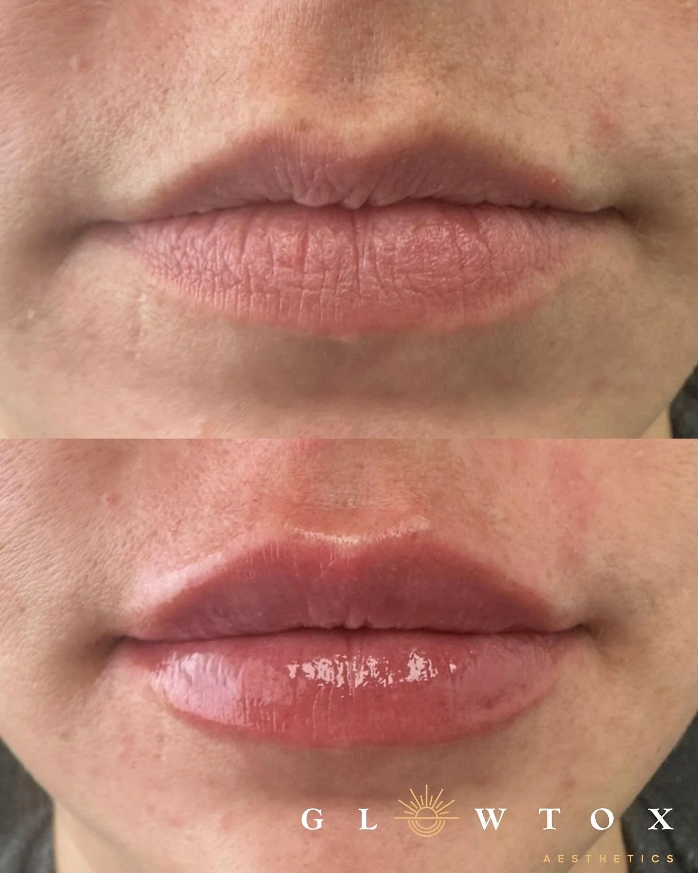 Every lip's dream is to be hydrated and juicy 👄💦🍉 And dreams come true at Glowtox 🤩🌟 

September Lip Filler Deals 👄
⭐️ Buy 50 units of Botox, Get lip filler 50% off
⭐️ Buy 1 syringe, Get 1 50% off

📲 Book with the link in bio 
☎️ Call (855) 45