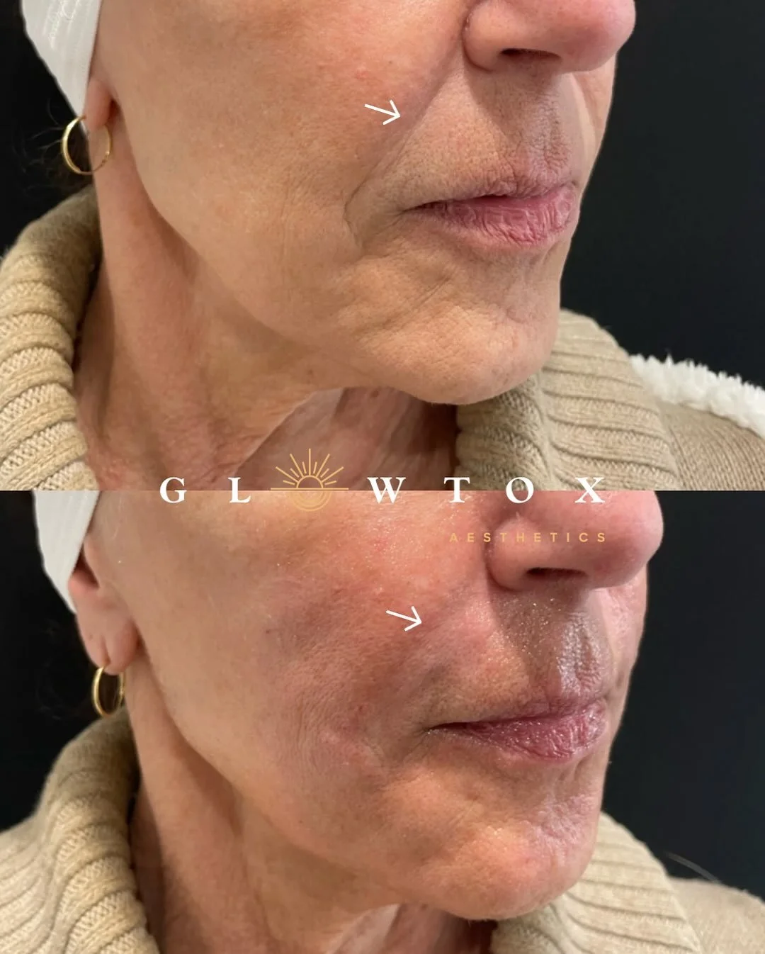 Naturally Glowing Results by NP Tiffany ✨

Book a filler consultation before the holiday rush ✨
📲 Visit the link in bio 
☎️ Call (855) 456-9869

#filler #radiantskin #healthyskin #freeconsultation #glowing #Glowtox #localbusiness #sdlocal #pblocal #