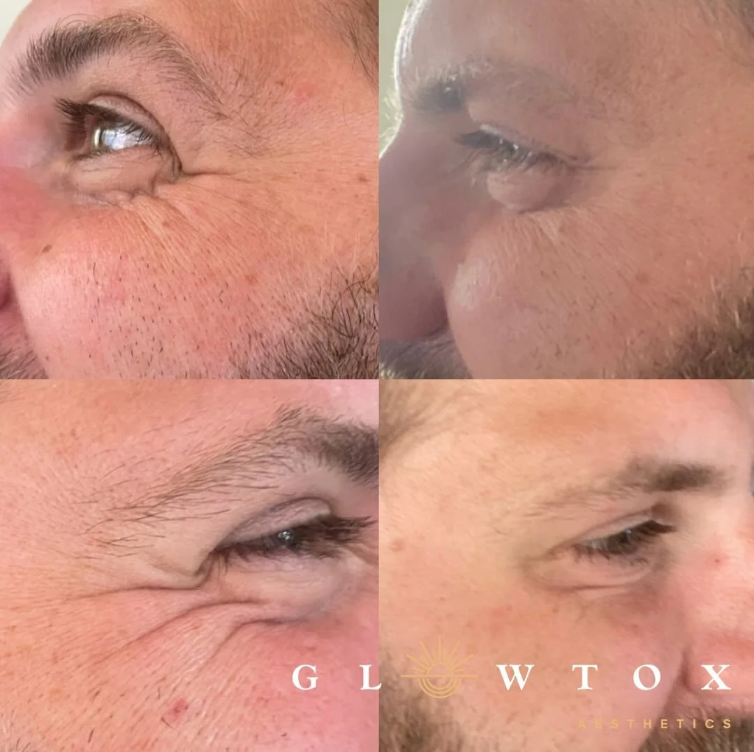Brotox: For the man who takes care of business.... And himself 💪🏼

✨ Tox subtly improving smile lines for the WIN

📲 Book with the link in bio 
☎️ Call (855) 456-9869

#BROTOX #GLOWTOX #manager #aestheticnurse #filler #tox #dysport #botox #nurseli