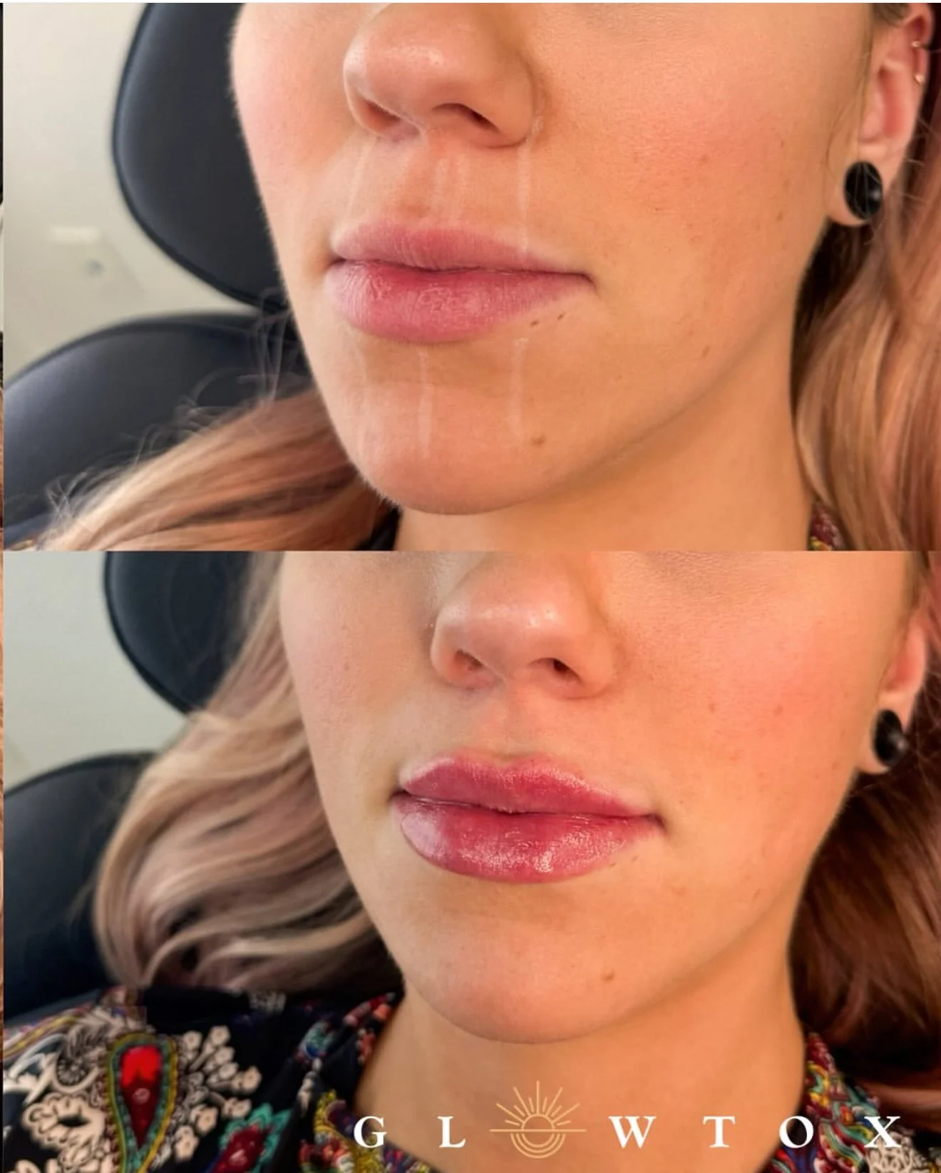 Everything You Need to Know About Lip Fillers in Pacific Beach