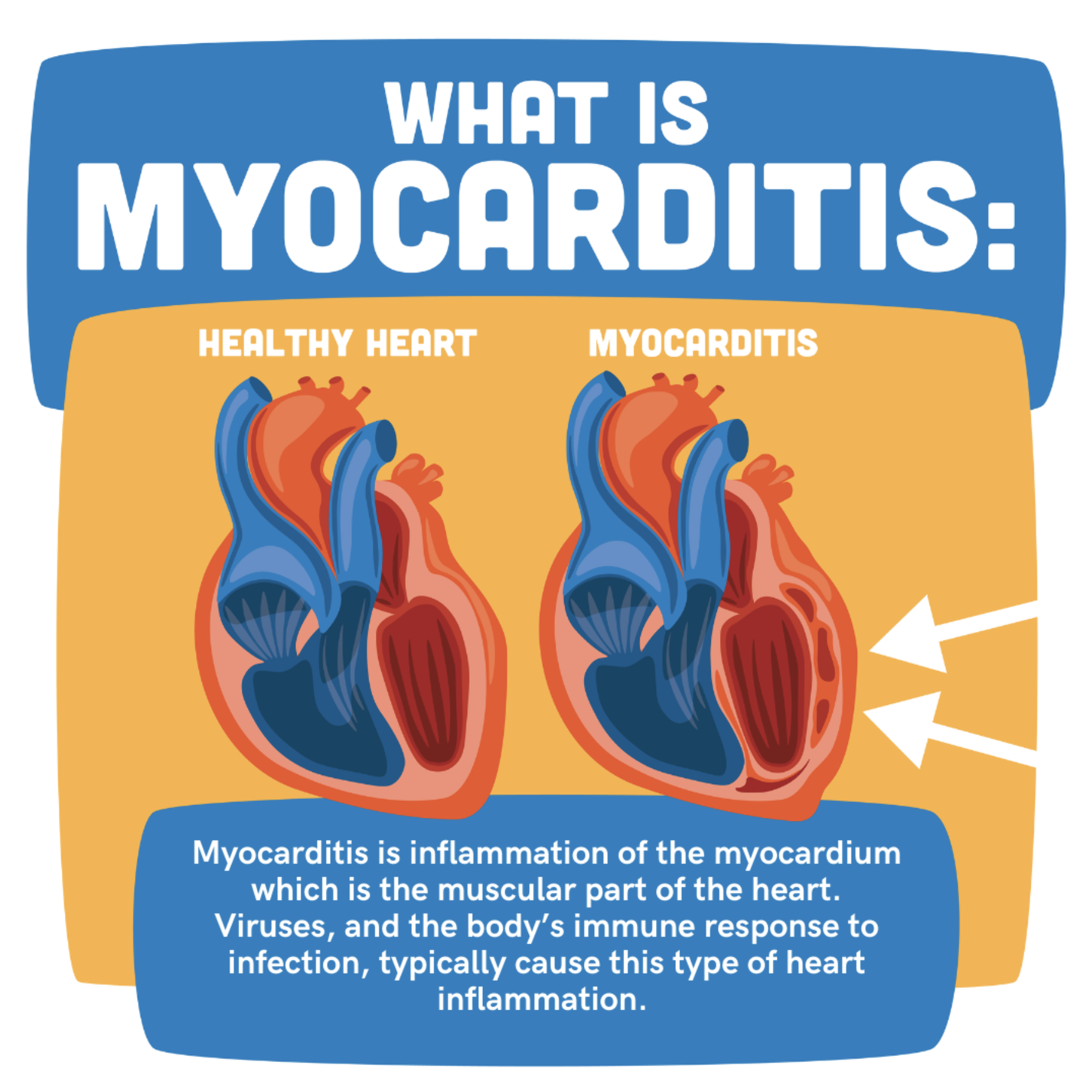 myocarditis