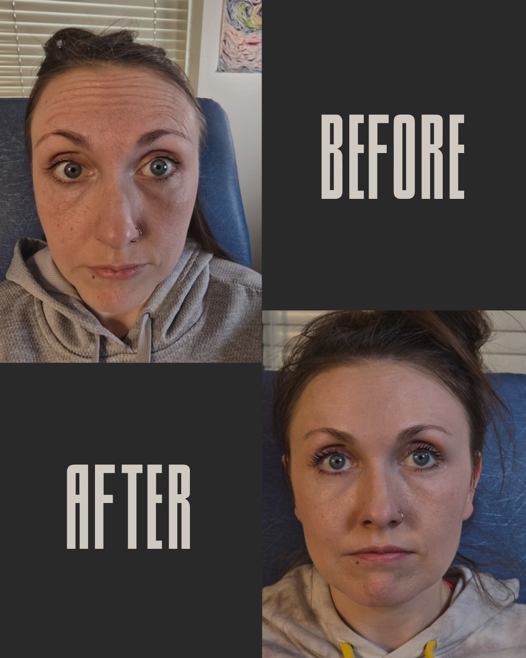 Comparison of a woman's face before and after skincare treatment, showing improvement in skin texture and complexion.